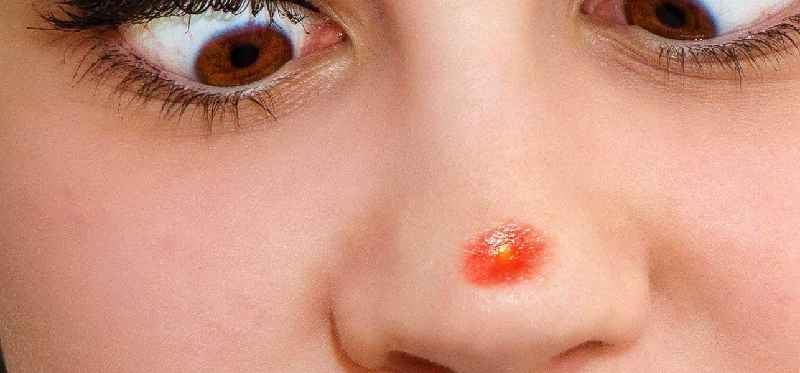 Can estheticians pop pimples