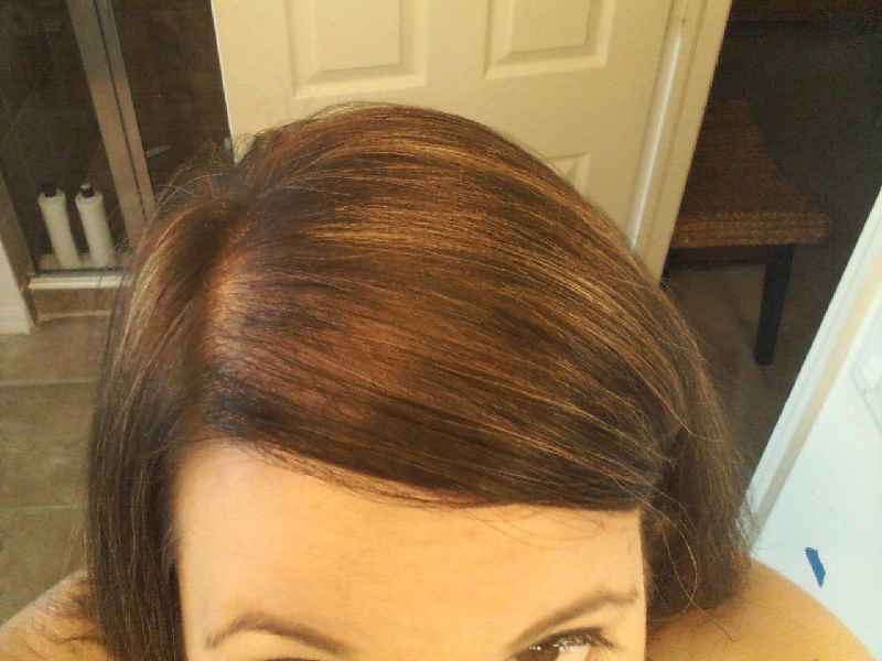 Can female hair thinning be reversed