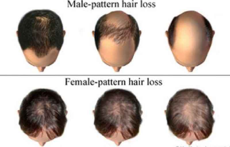 Can female pattern hair loss be stopped