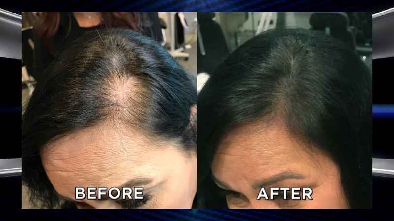 Can female thinning hair be reversed