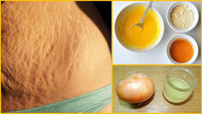 Can glycerin remove stretch marks