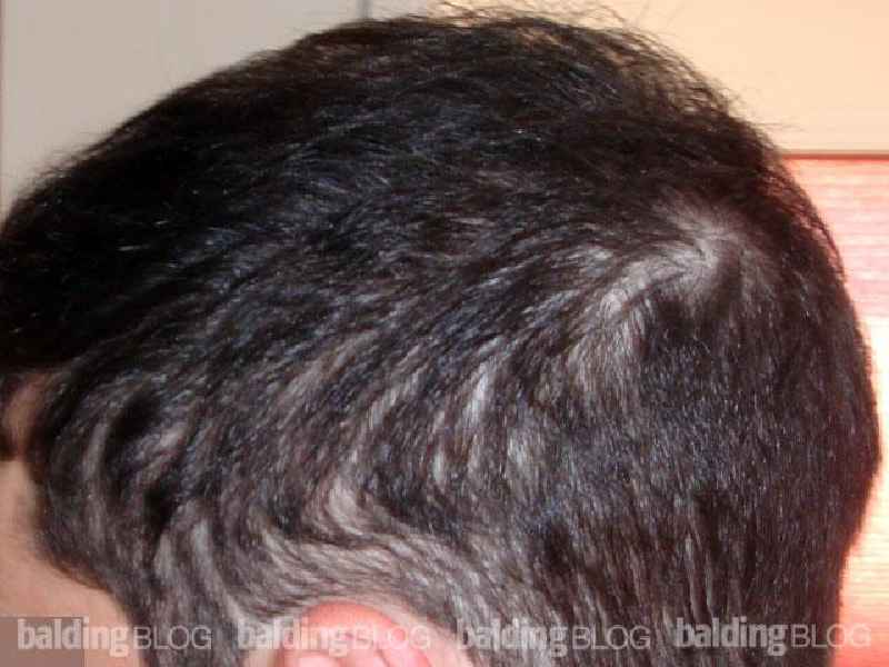 Can hair grow back after thinning