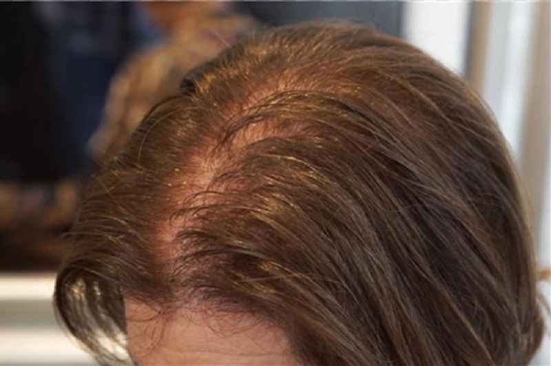 Can hair grow back after thinning female