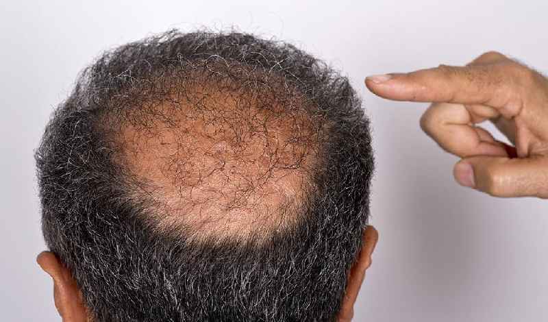 Can hair loss be repaired