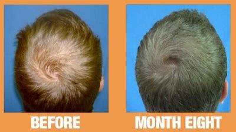 Can hairloss reversed