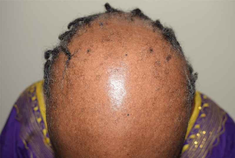 Can HPV cause hair loss