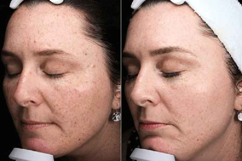 Can I exercise after facial laser treatment