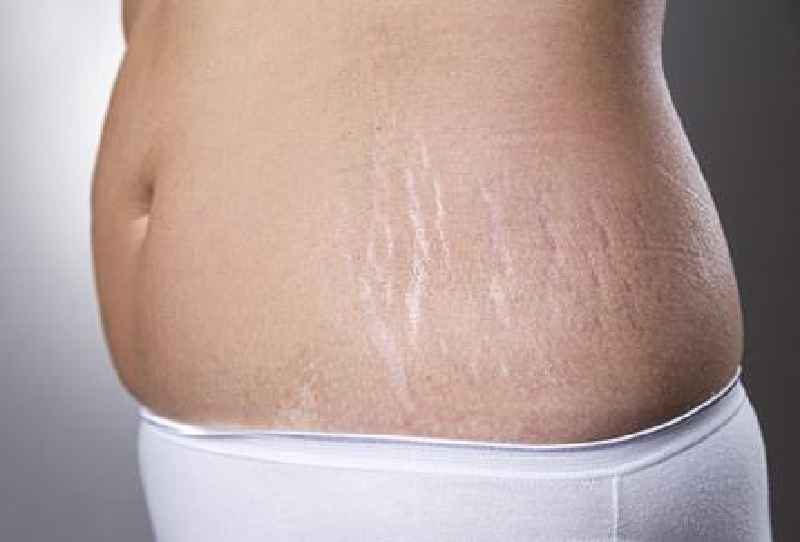 Can I get lipo if I have stretch marks
