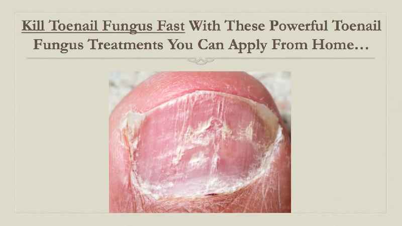 Can I put alcohol on toenail fungus