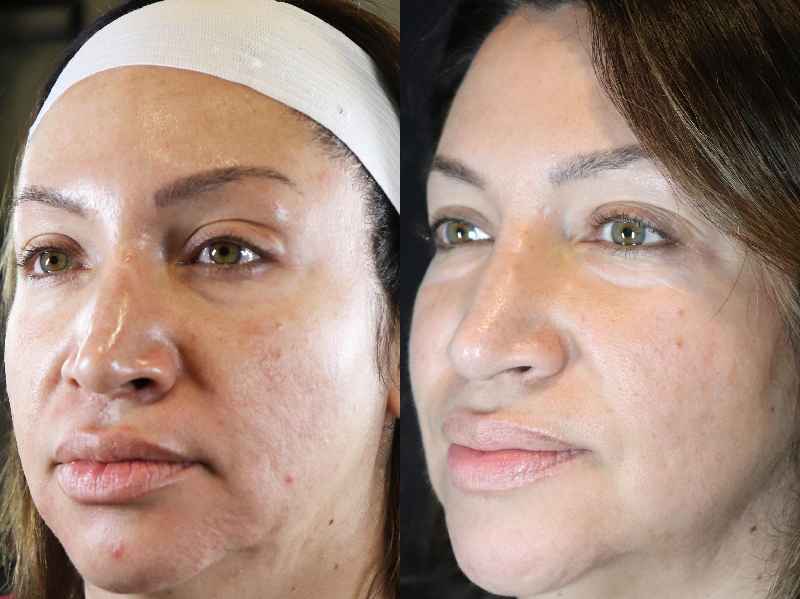 Can I put lotion on after Microneedling