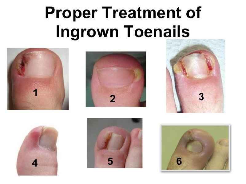 Can I put Neosporin on an ingrown toenail