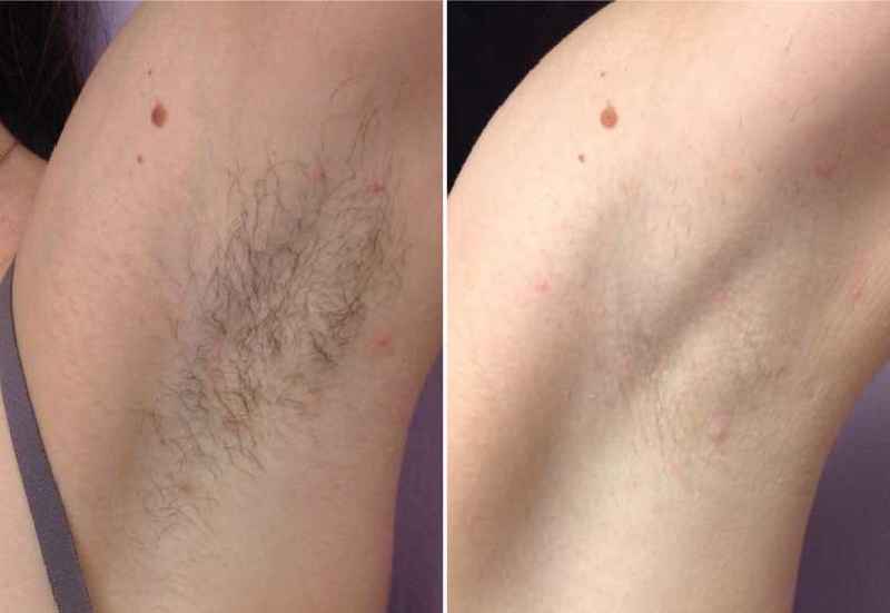 Can I shave 5 hours before laser hair removal