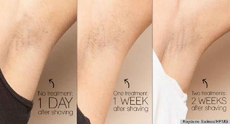 Can I shave two days before laser hair removal