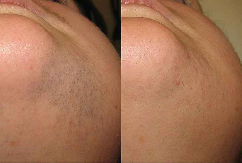 Can I use moisturizer before laser hair removal