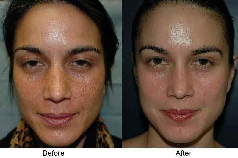 Can I use Vitamin C after chemical peel