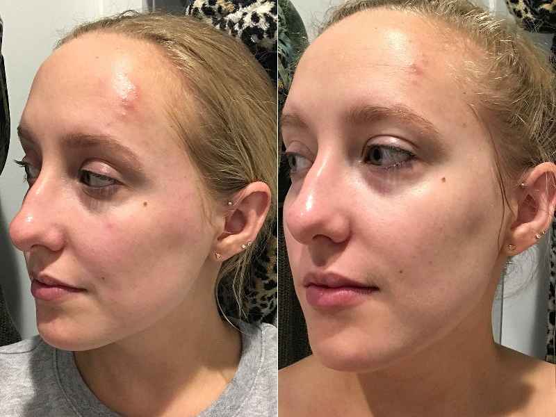 Can I use vitamin E on my face after a chemical peel