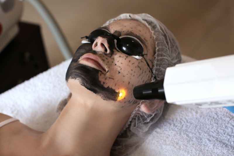 Can I wash face after laser treatment