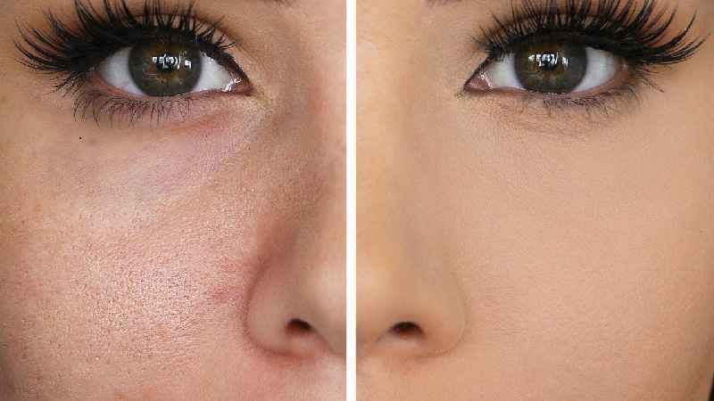 Can large pores be lasered
