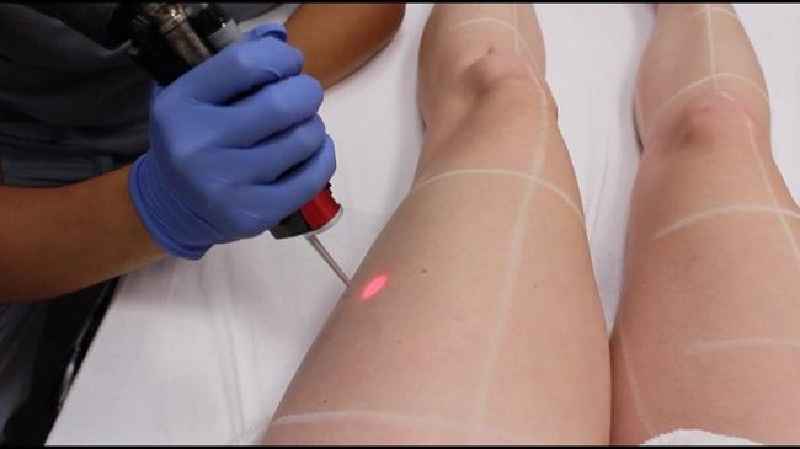Can laser hair removal get rid of Strawberry legs