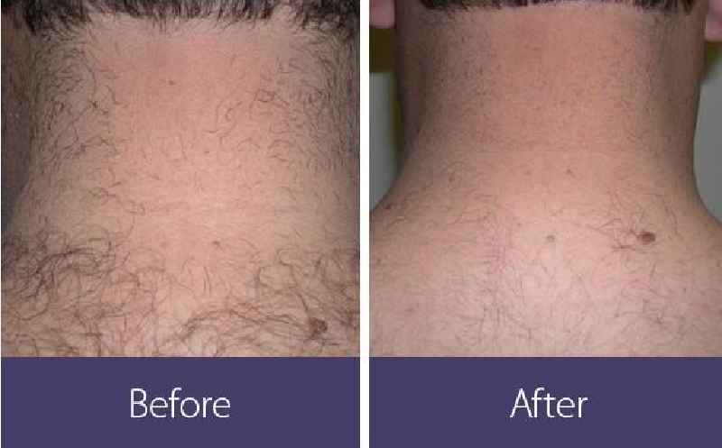 Can laser hair removal remove coarse hair