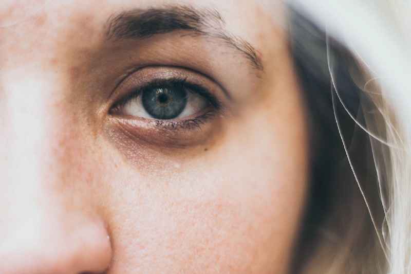 Can laser remove bags under eyes