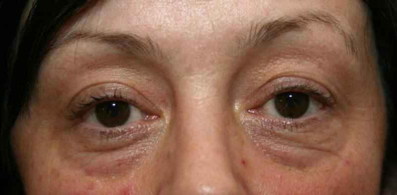 Can laser remove bags under eyes