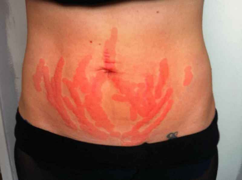 Can laser treatment remove stretch marks