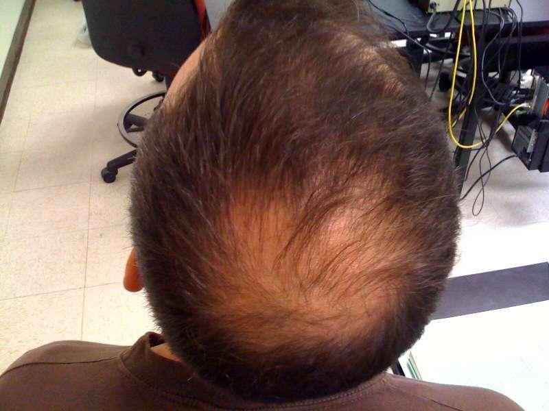 Can low B12 cause hair loss