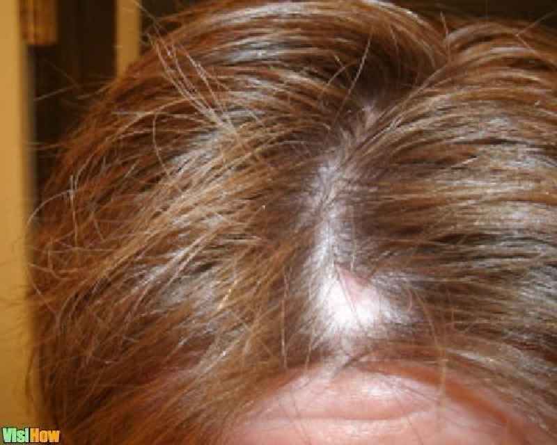 Can low iron cause hair loss