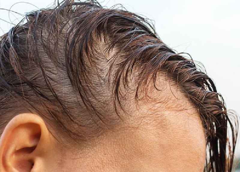 Can low magnesium cause hairloss