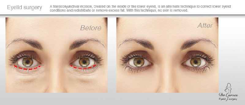 Can lower eyelid surgery be done with local anesthesia