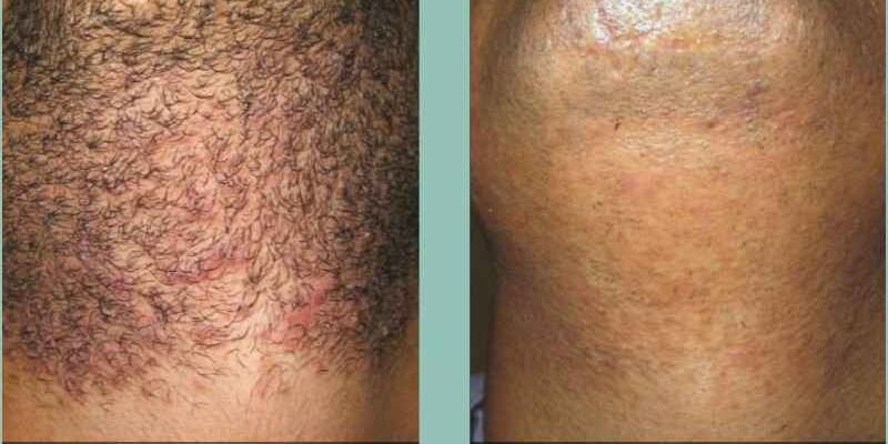 Can men remove facial hair with laser