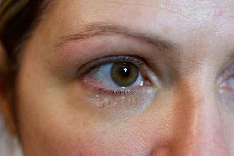 Can microneedling get rid of wrinkles