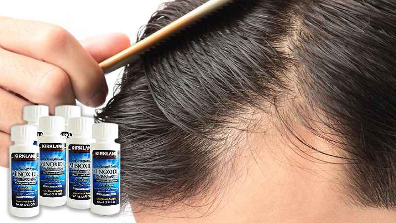 Can minoxidil worsen hair loss