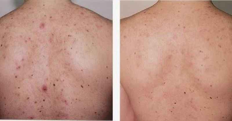 Can moisturizer remove acne