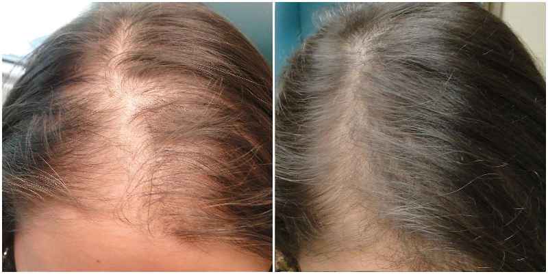 Can multivitamins cause hair loss