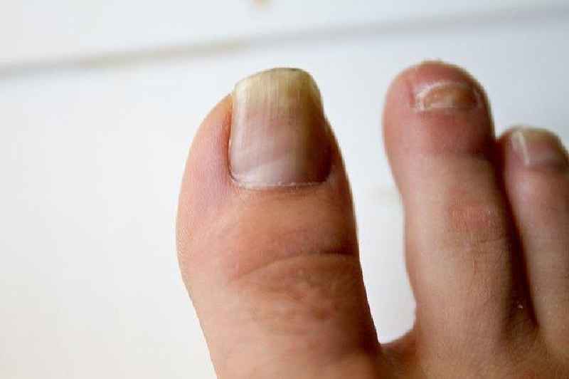 Can nail fungus clear up on its own