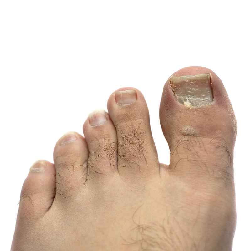 Can nail fungus go away by itself