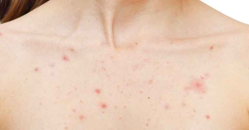 Can niacinamide cause acne