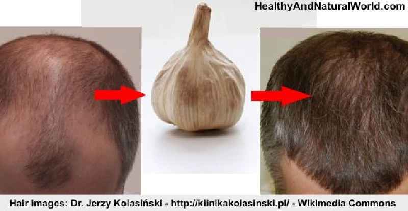 Can onion juice remove baldness