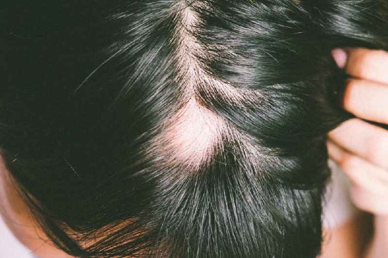 Can parabens cause hair loss