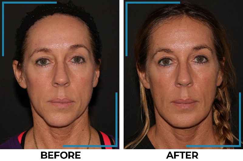 Can Plastic Surgery remove frown lines