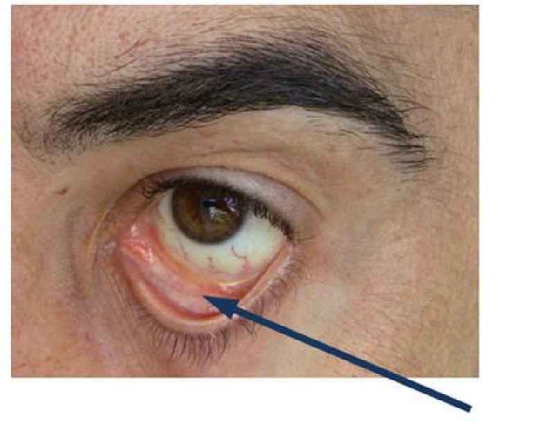 Can PRP be done on eyelids