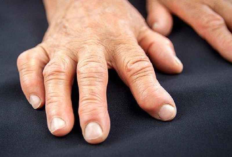 Can Rheumatoid arthritis cause hair loss