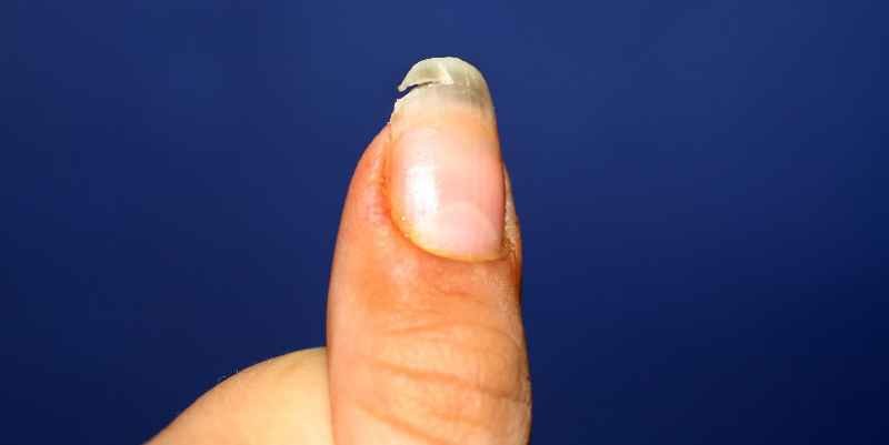 Can split nail grow back together