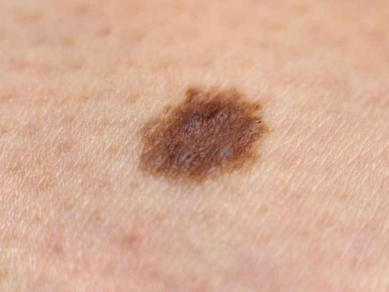 Can subungual melanoma be benign