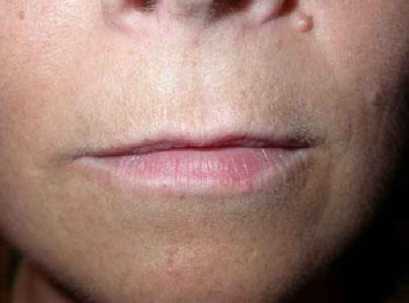 Can thin lips get filler