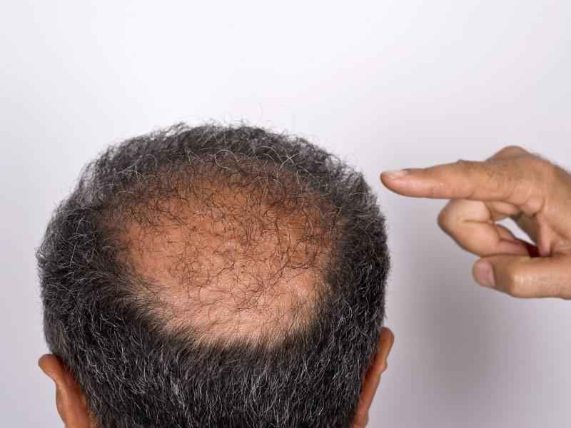 Can thinning hair grow back