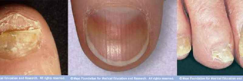 Can toenail fungus spread in the bathtub