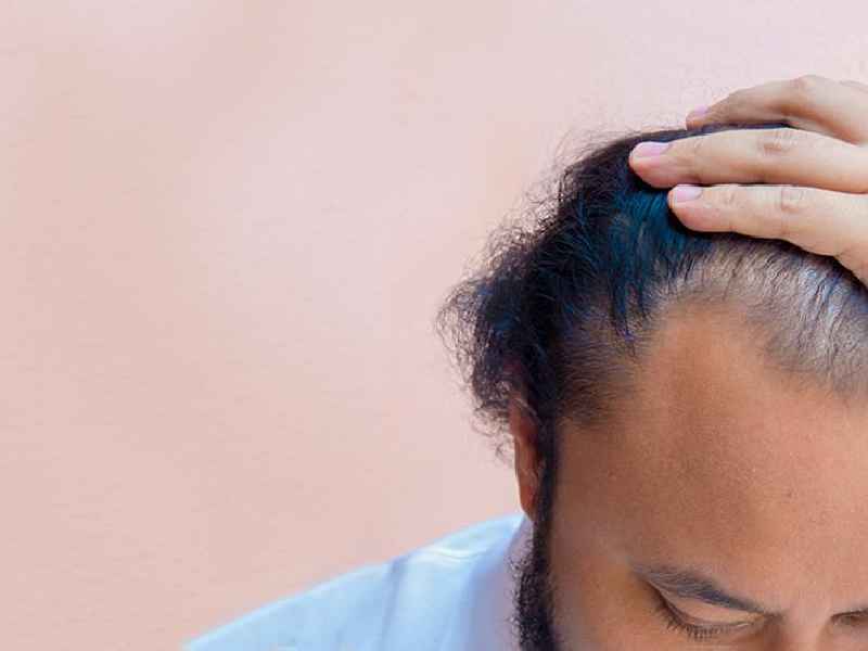 Can too much progesterone cause hair loss